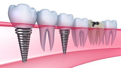 Implantaten weer vergoed door VGZ