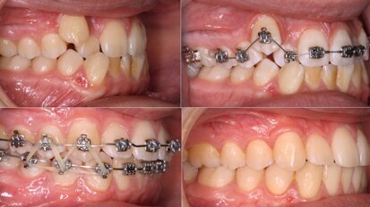 ¿Extracción o Expansión en Ortodoncia? (4)