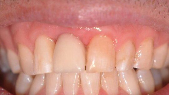 “One miracle at a time” – an implant case report