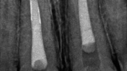 Irrigating the root canal: A case report
