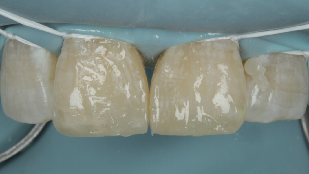 Fig 18. Final Enamel layer is contoured with A3 Enamel and light cured.