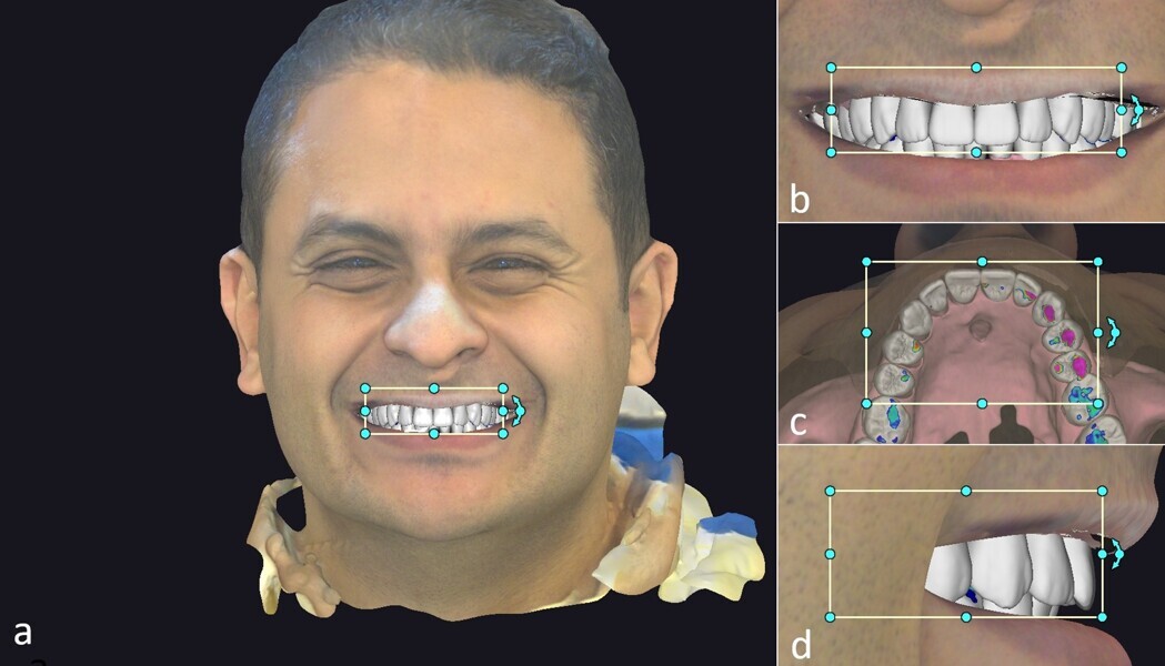 Figs. 2a–d: The tooth library was positioned over the intra-oral scan and aligned with facial landmarks (a). The frontal view confirmed the incisal edge position and smile line (b). The occlusal view was used for contour planning (c). The lateral view verified the tooth position and smile design (d).