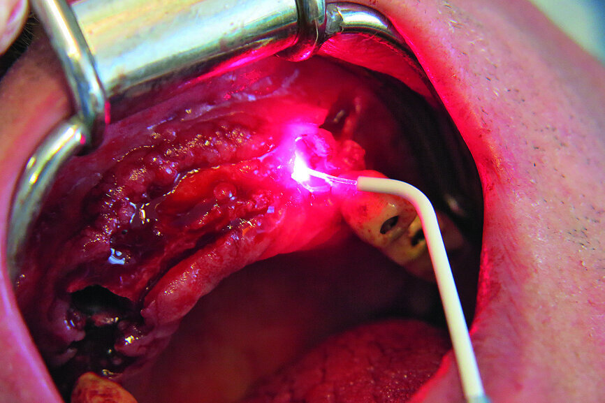Fig. 9: HELBO laser therapy in order to reduce bacteria.