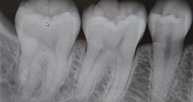 Vitamin-D-Mangel auf Röntgenbildern erkennbar