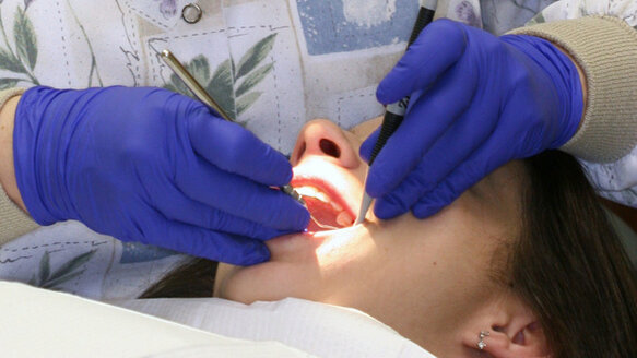 Individuato un nuovo batterio, causa delle carie infantili