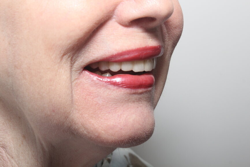 Fig. 25: Postoperative lateral smile.