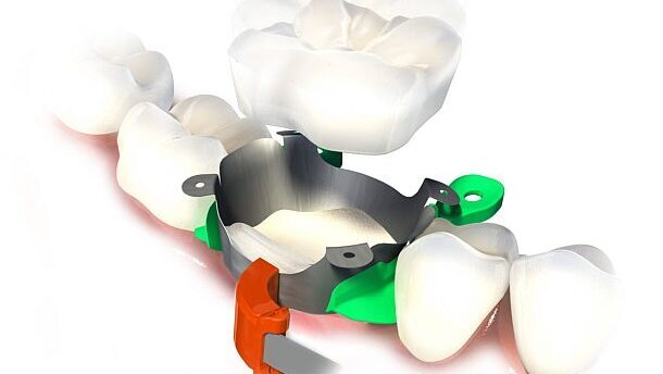 Een kroon in slechts 30 minuten? ONE VISIT CROWN Rhondium!