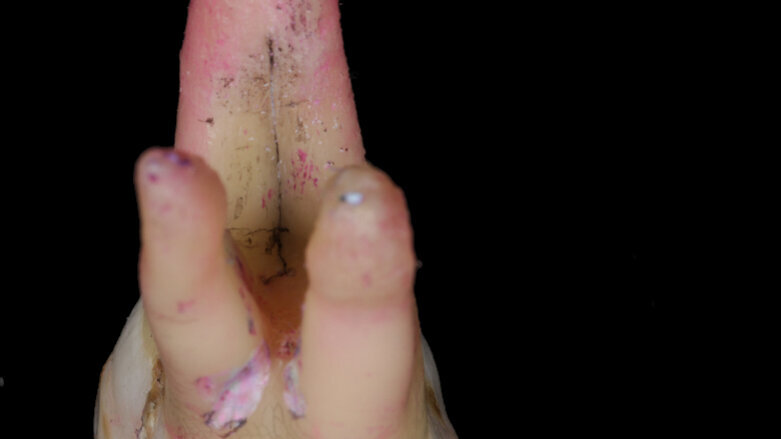 Cracking the code of fractured teeth