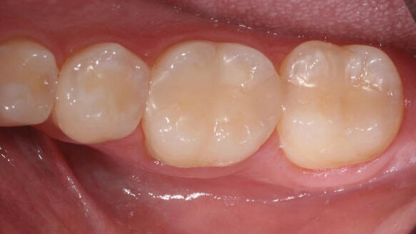 Nanohybrid composite solutions that patients love