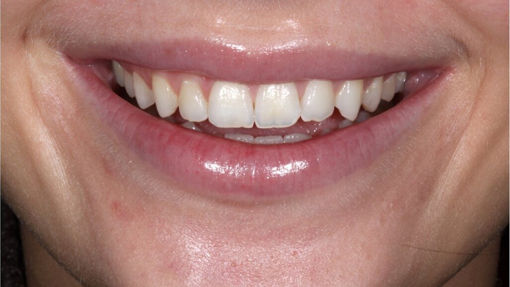 Verbeter je glimlach met composiet