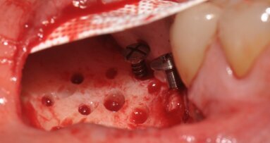 GBR Pocket Technique