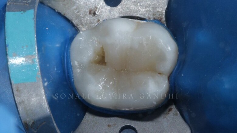 Fig 12: Disto-buccal Cusp