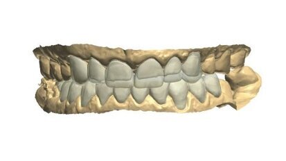 Kompleksowa rehabilitacja zwarcia z wykorzystaniem skanera wewnątrzustnego