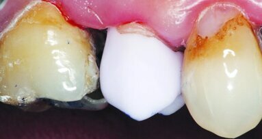 Simple and efficient crown fabrication with an advanced CAD/CAM system
