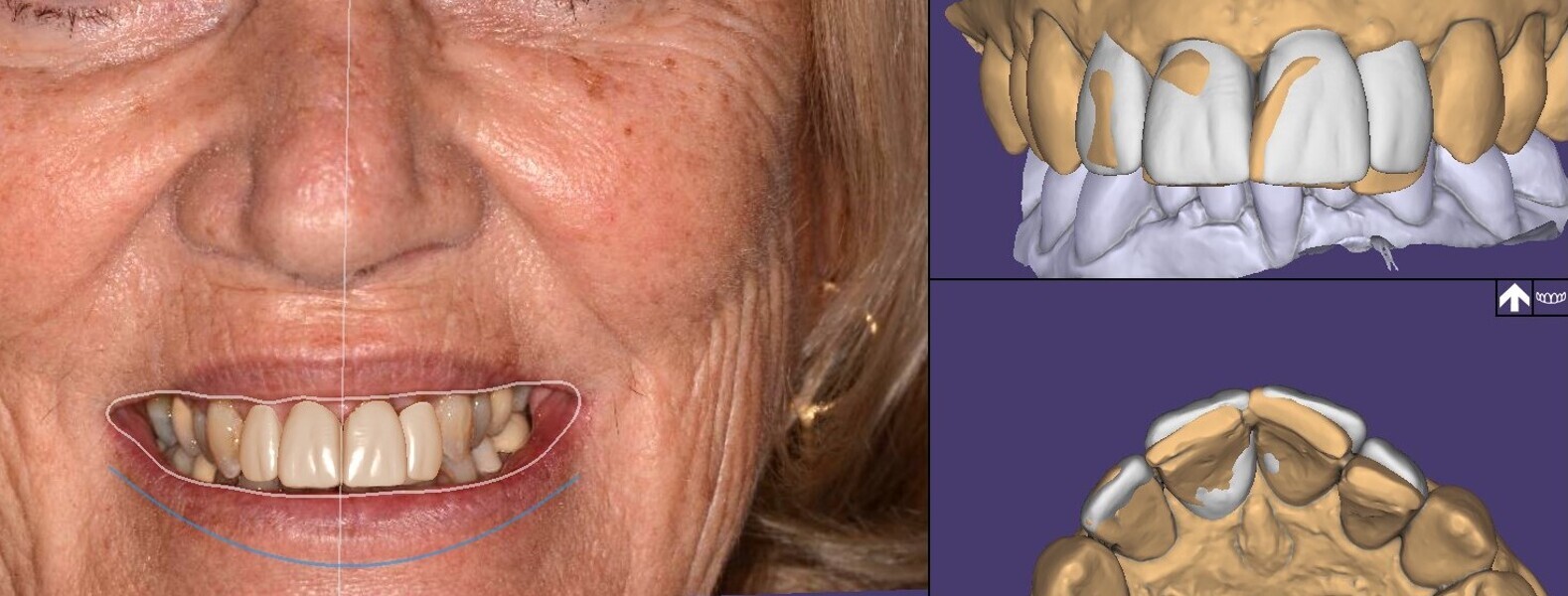 Fig. 15 : 2D, 3D et 4D dans DentalCAD 3.1 Rijeka (exocad).