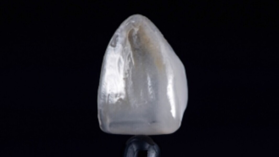 Fig. 5. Carilla caracterizada con maquillajes fotopolimerizables, antes de la colocación.