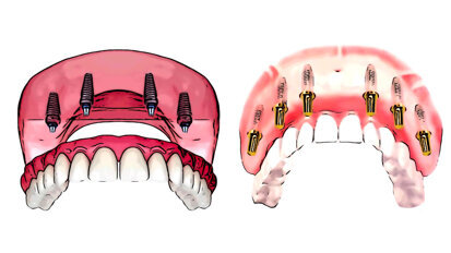 Mise en charge immédiate ou différée chez l’édenté complet maxillaire