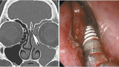 רופאים גילו שתל דנטלי בחלל האף