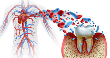Alle vier großen Volkskrankheiten sind mit Parodontitis assoziiert