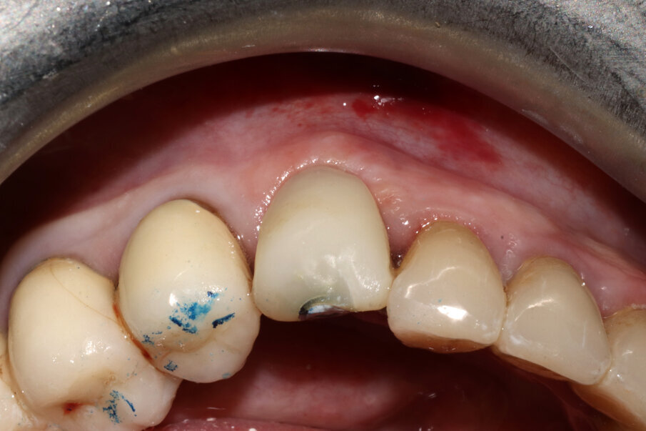 Figg. 9-11_Inserimento dell’impianto e costruzione di una corona provvisoria. Si noti la forma a “C” dello shield e, al termine dell’intervento, la compostezza dei tessuti, gestiti senza alcun tipo di lembo.