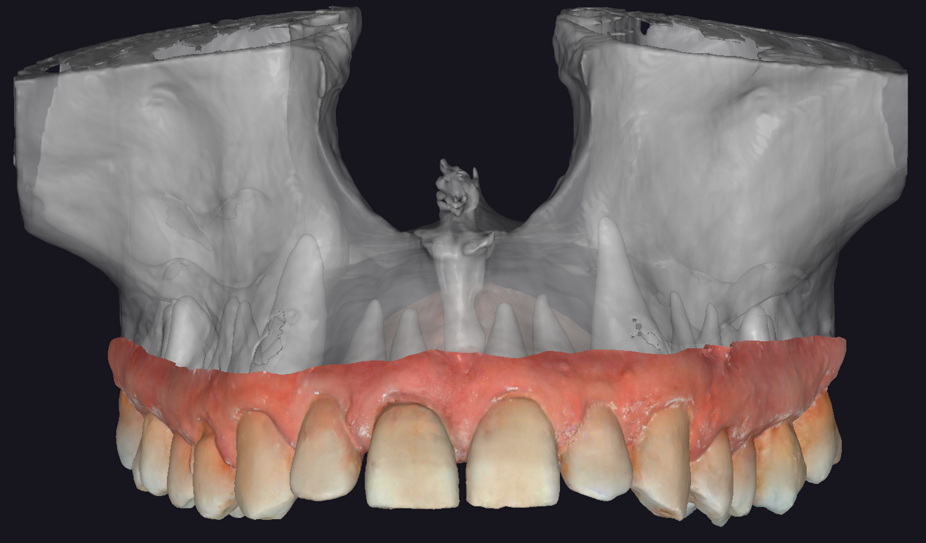 Fig. 2: Pre-op maxillary intra-oral scan superimposed with CBCT segmentation, anterior view.