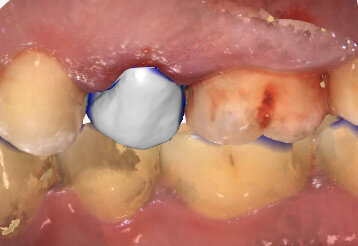 Fig. 3_Impronta digitale post-operatoria. Si evidenzia la realizzazione di una corona provvisoria immediata.