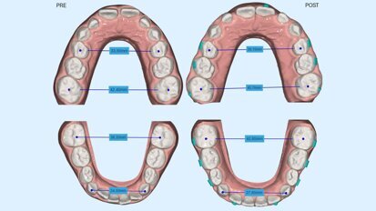 Il trattamento con allineatori in età preadolescenziale: la sfida di Nuvola Genius