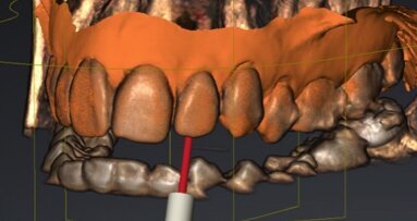 Calcified canals: A new approach to an old problem