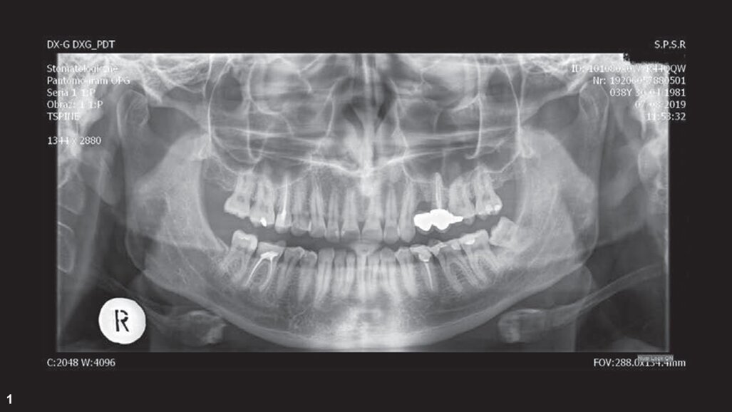 伴复杂根管系统的左侧上颌第一磨牙的 牙髓治疗