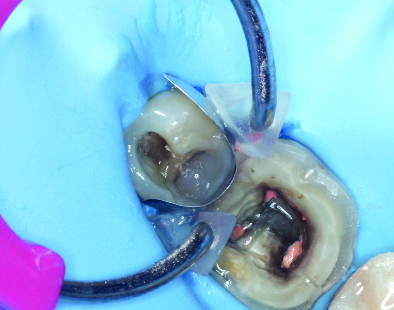 Fig. 4: Building the distal wall to convert the cavity from a Class II to a Class I configuration.