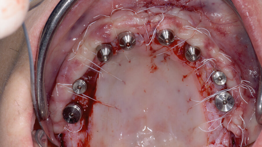 Obr. 11: Závěrečné sešití při čtvrté chirurgické fázi.