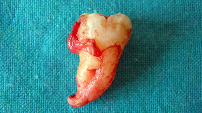 La chirurgia dell’ottavo inferiore: diagnosi, indicazioni cliniche e valutazione degli esiti negativi