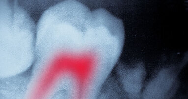 Une étude révèle que la douleur post-traitement endodontique a différentes sources