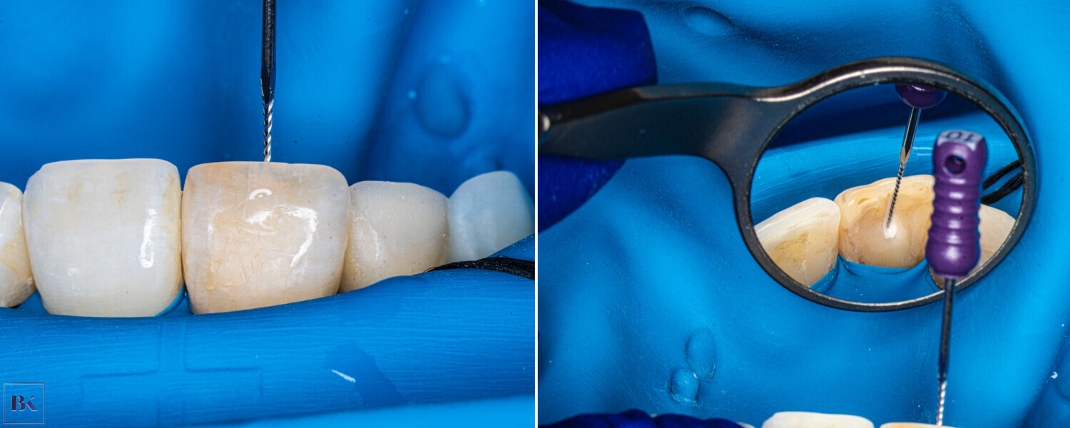 Figs. 7a & b: Hand file scouting of the canal orifice.