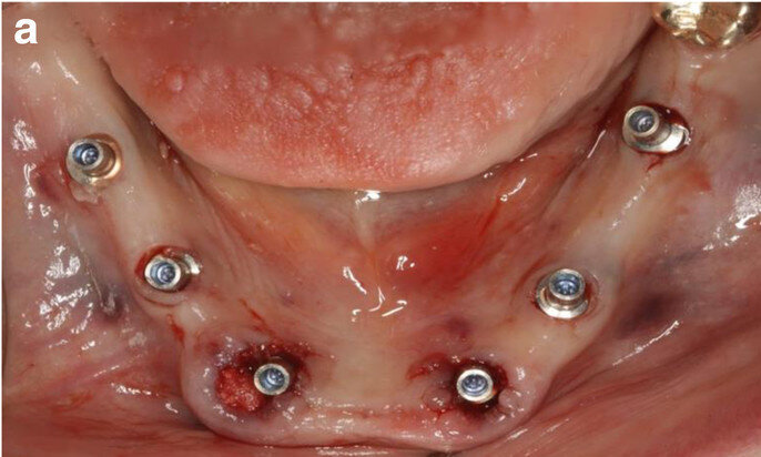 Fig. 9a: Occlusal views of the abutments (a) and of the immediate provisional restoration that were passively bonded in situ (b).