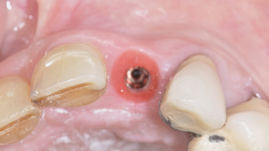 Fig. 11_Condizionamento dei tessuti molli. 