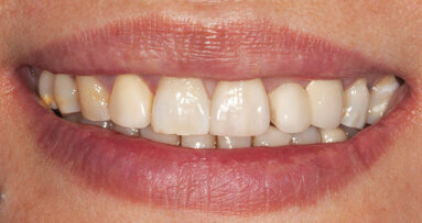 Anterior BruxZir Solid Zirconia Crown