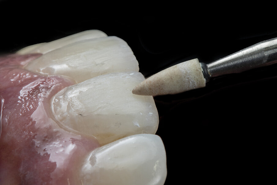 Fig. 12: After contouring, finishing done with dura white stone