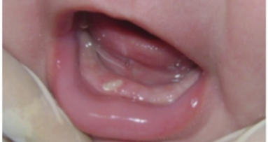 Tratamiento de úlcera de Riga-Fede en un bebé con antecedente de reacción adversa por uso de benzocaína