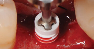 The next generation: Two-piece, metal-free screwed ZERAMEX XT