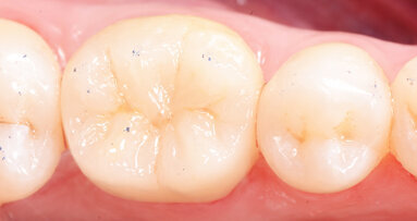 New materials for a classic indication