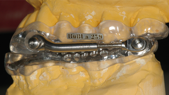 Apnoe- und Protusionsschienen helfen Schnarchern