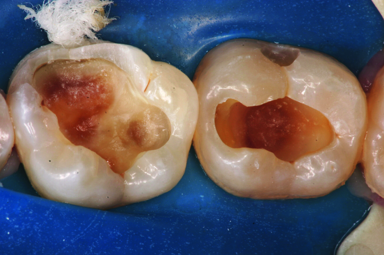 Fig. 2 : Cavité profonde après excavation de la carie.