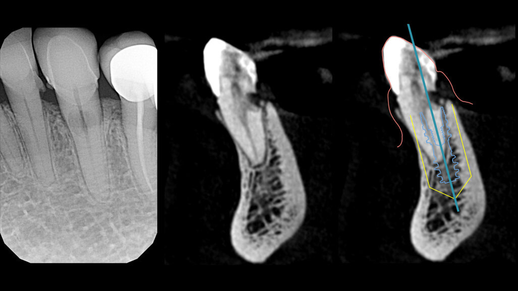 Riassorbimento radicolare esterno trattato con Socket-Shield Technique. Studio del matching degli STL e conferme volumetriche sui pattern di guarigione