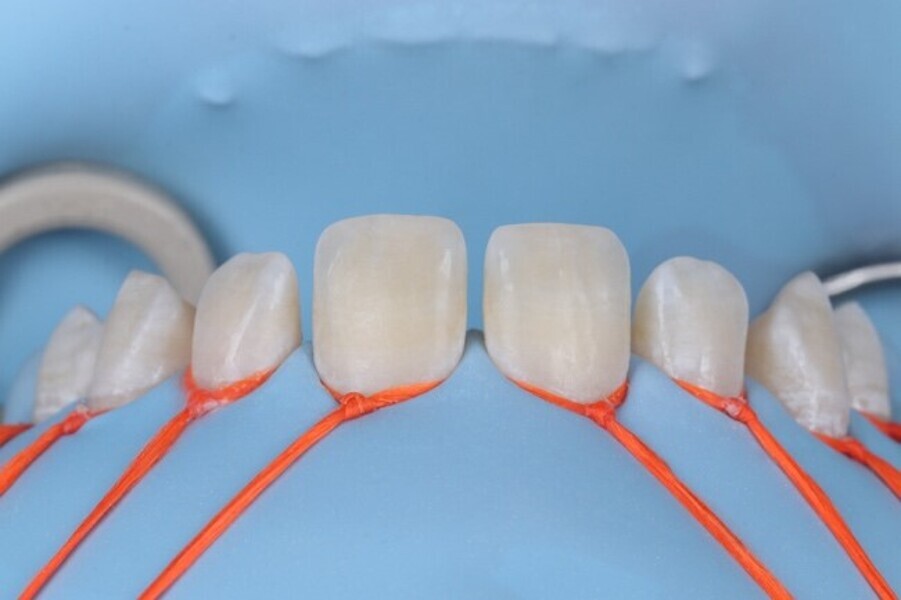 Fig. 3a: Rubber dam isolation in preparation to application of etchant and bonding agent.