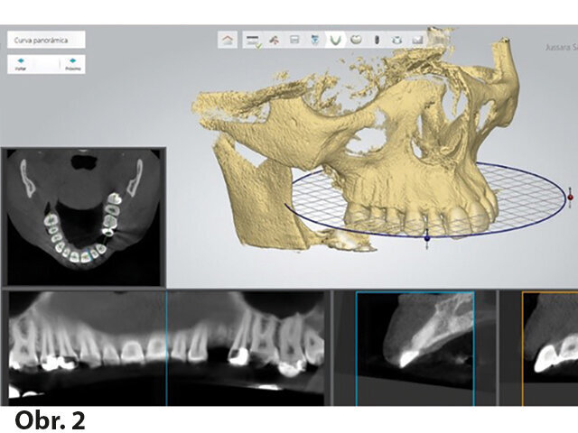 Sólo implantát: Kazuistika