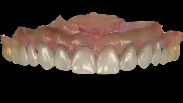 Fig. 12a. Planificación digital de las restauraciones provisionales.