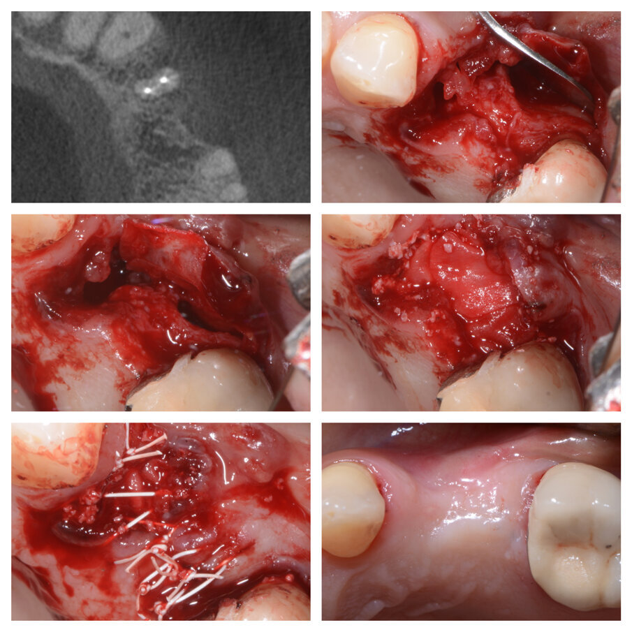 Fig. 6a_Perdita di elemento di ponte 24 e deficit in zona 25, fasi chirurgiche e guarigione.