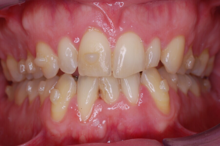 Fig. 34–36: Clinical progress after nine weeks of hybrid aligner treatment.