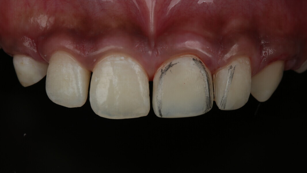 Fig 31: Primary anatomy was marked using a lead pencil.